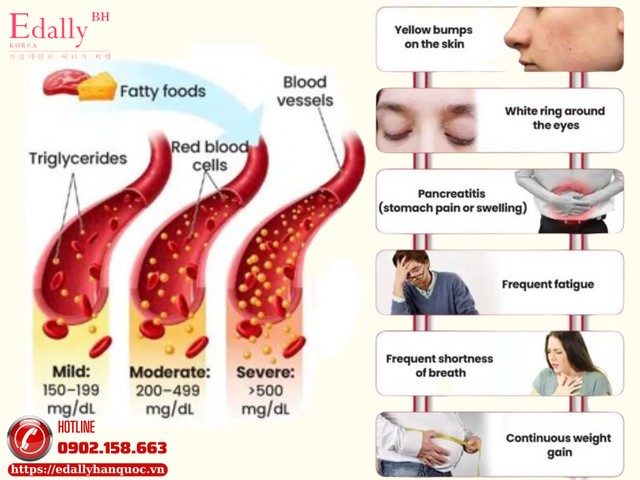 Vì sao nhiều người bị tăng triglyceride máu sau Tết?